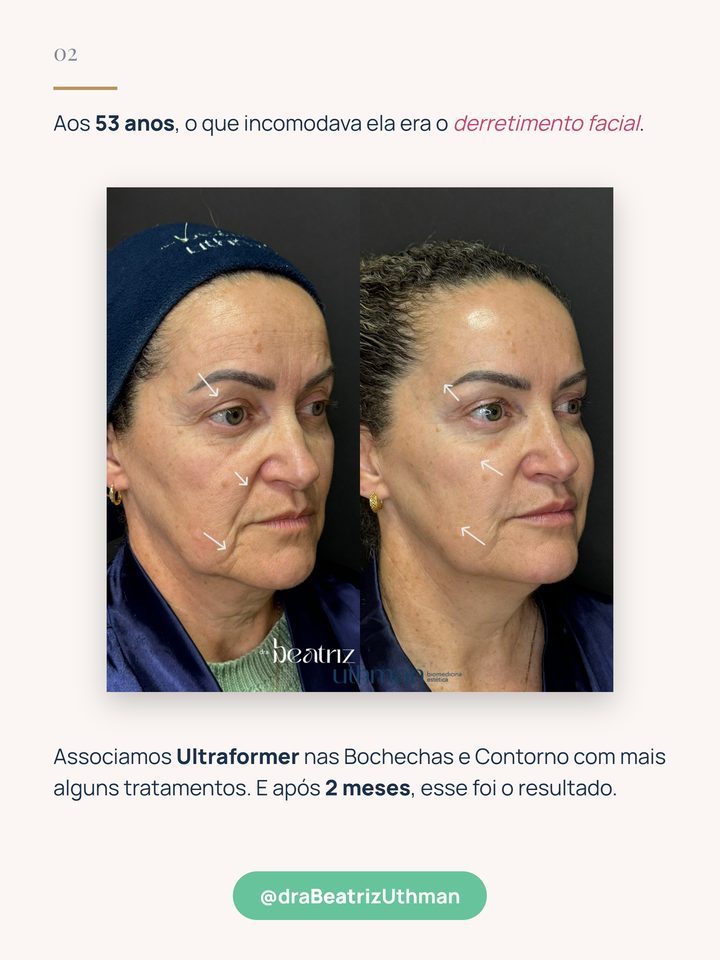 Caso 1: paciente de 53 anos, antes e depois de 2 meses, Ultraformer nas bochechas e no contorno associado a outros tratamentos