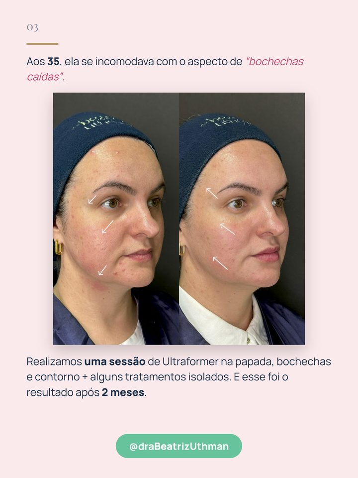 Caso 2: paciente de 35 anos, antes e depois de 2 meses, uma sessão de Ultraformer na papada, bochechas e contorno