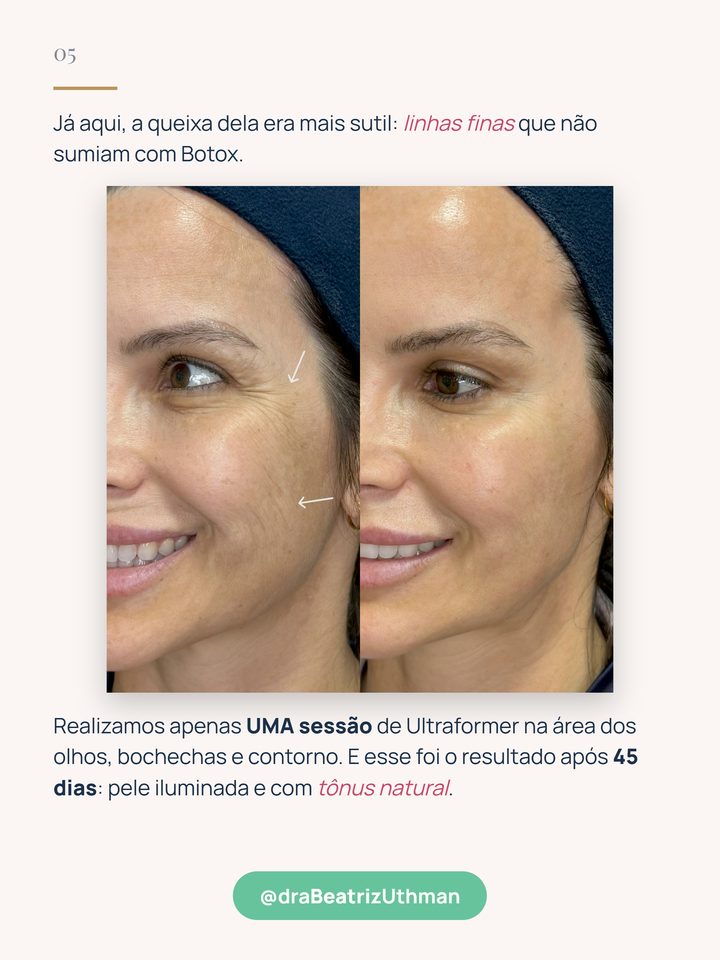 Caso 4: antes e 45 dias depois de uma sessão de Ultraformer na área dos olhos, bochechas e contorno