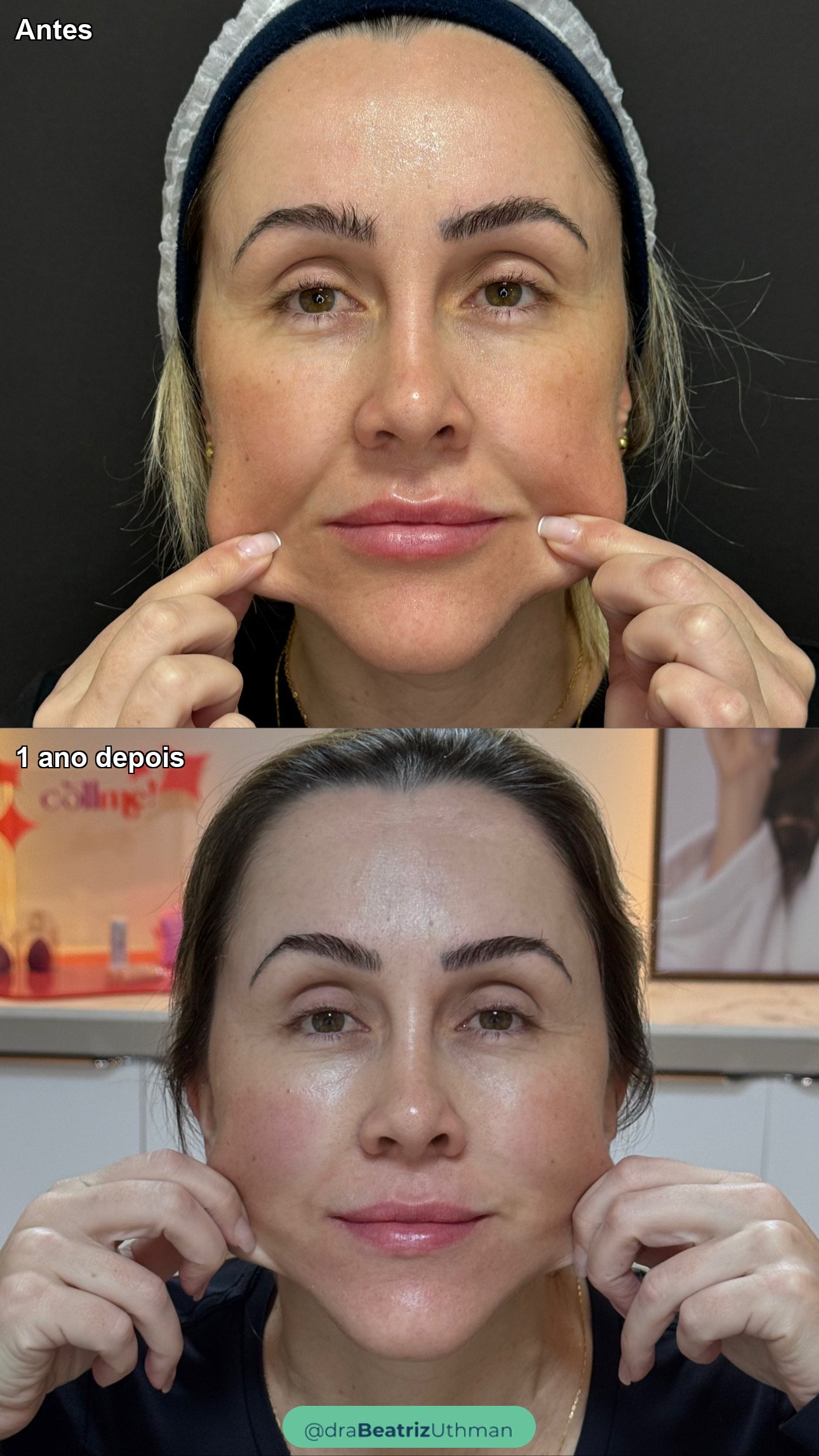 Bioestimulador · Caso 1: antes e depois