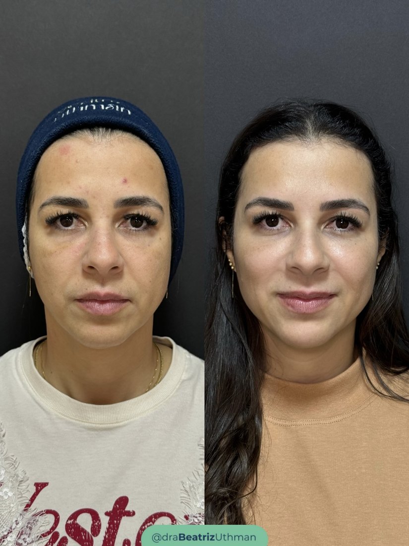 Bioestimulador · Caso 2: antes e depois