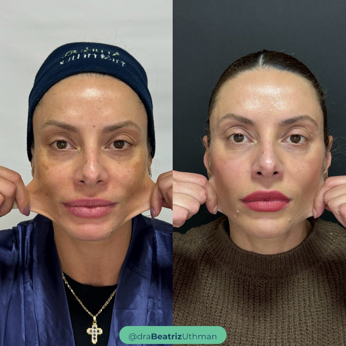 Bioestimulador · Caso 3: antes e depois