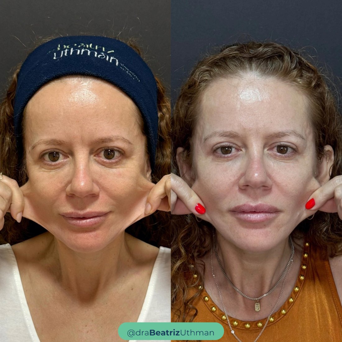 Bioestimulador · Caso 4: antes e depois