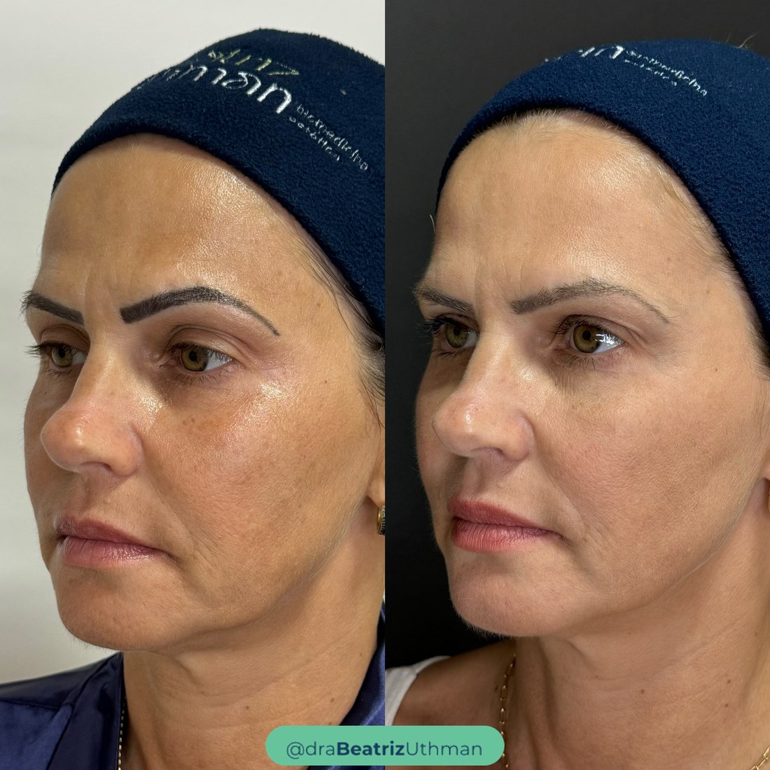 Bioestimulador · Caso 5: antes e depois