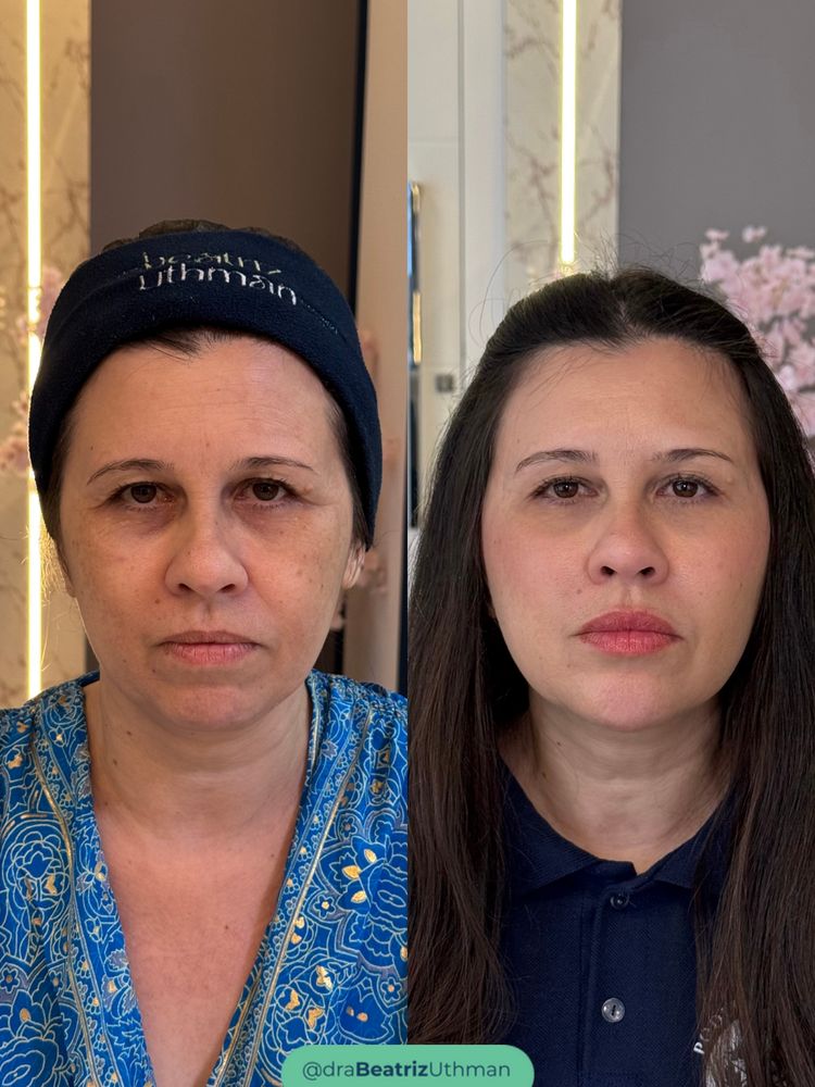 Caso 2 do Método B.Up: antes e depois