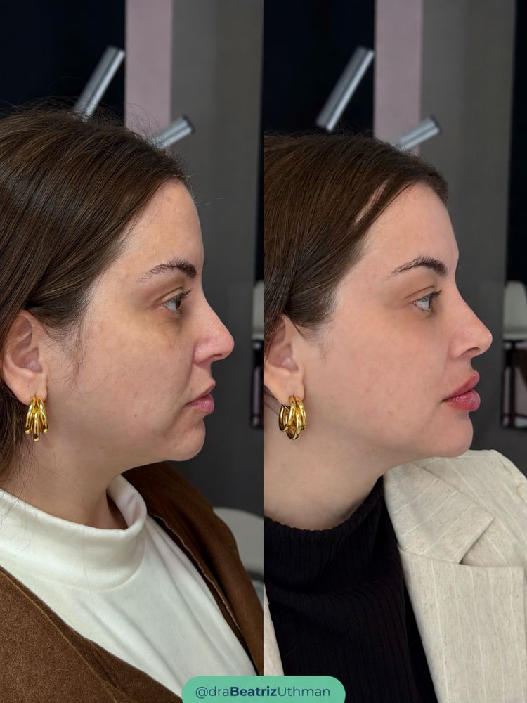 Método B.Up · Caso 4: antes e depois