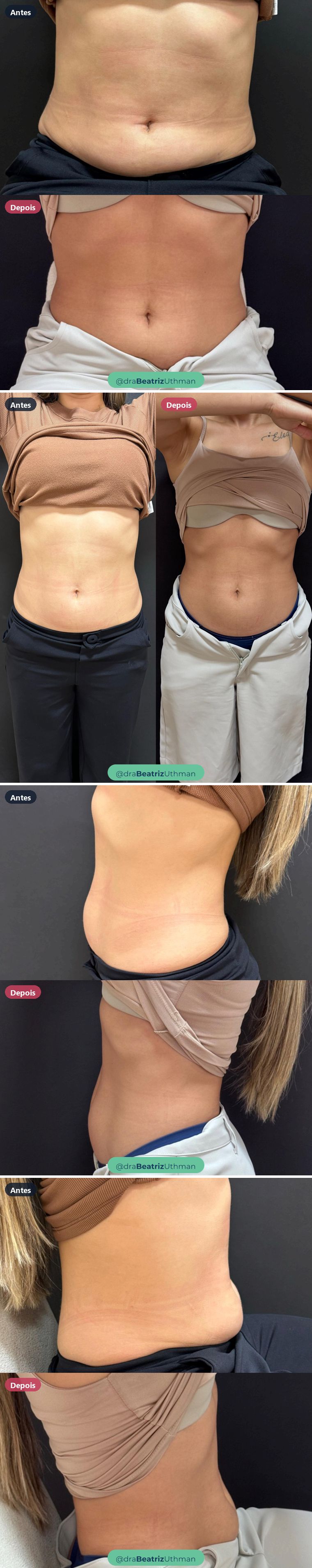 Corporal · Caso 1: antes e depois