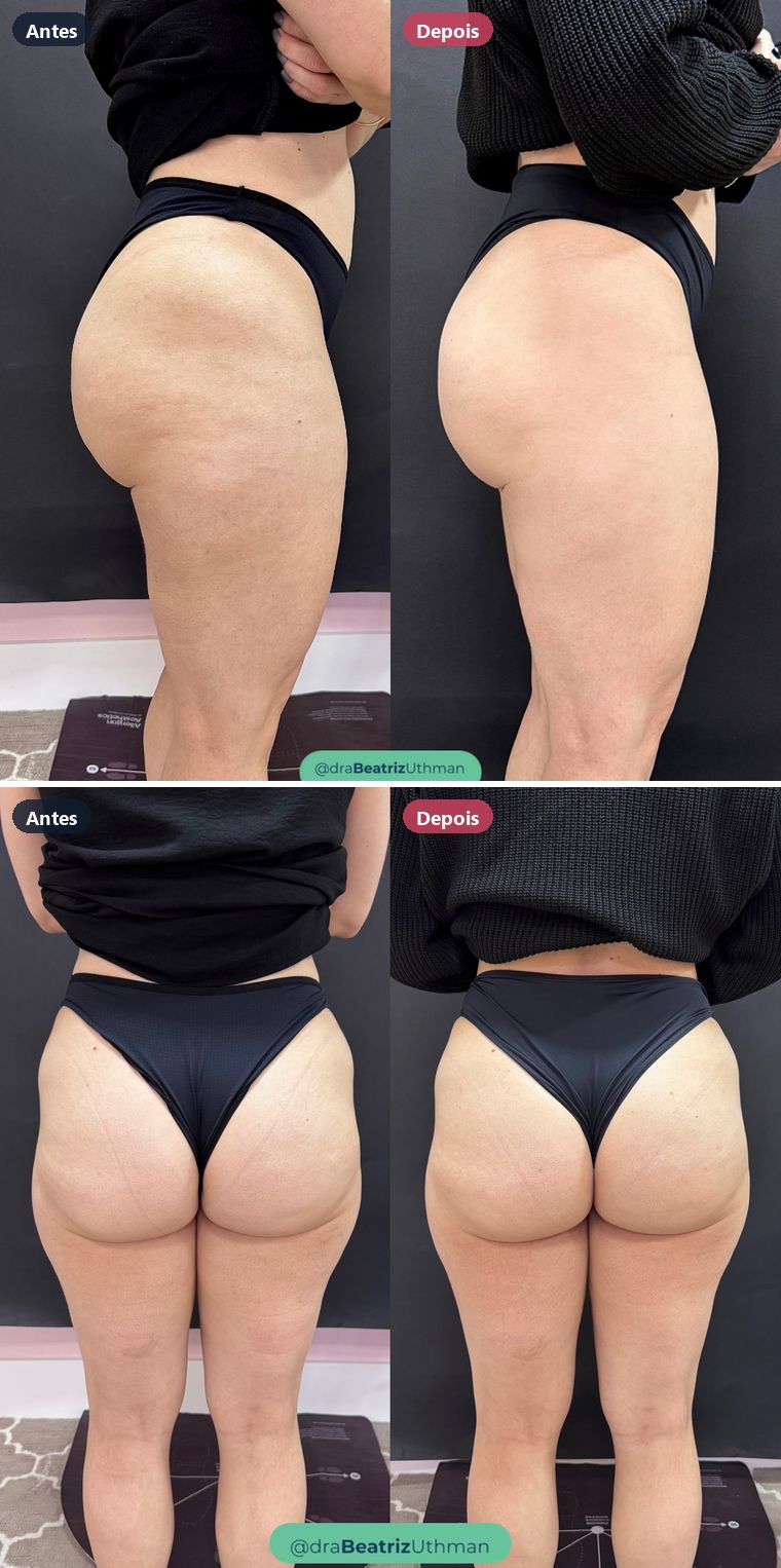 Corporal · Caso 2: antes e depois