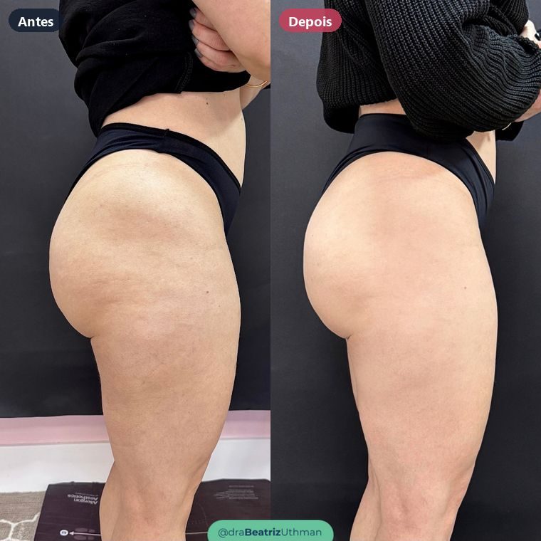 Bumbum de uma paciente do consultório, de perfil, antes e depois