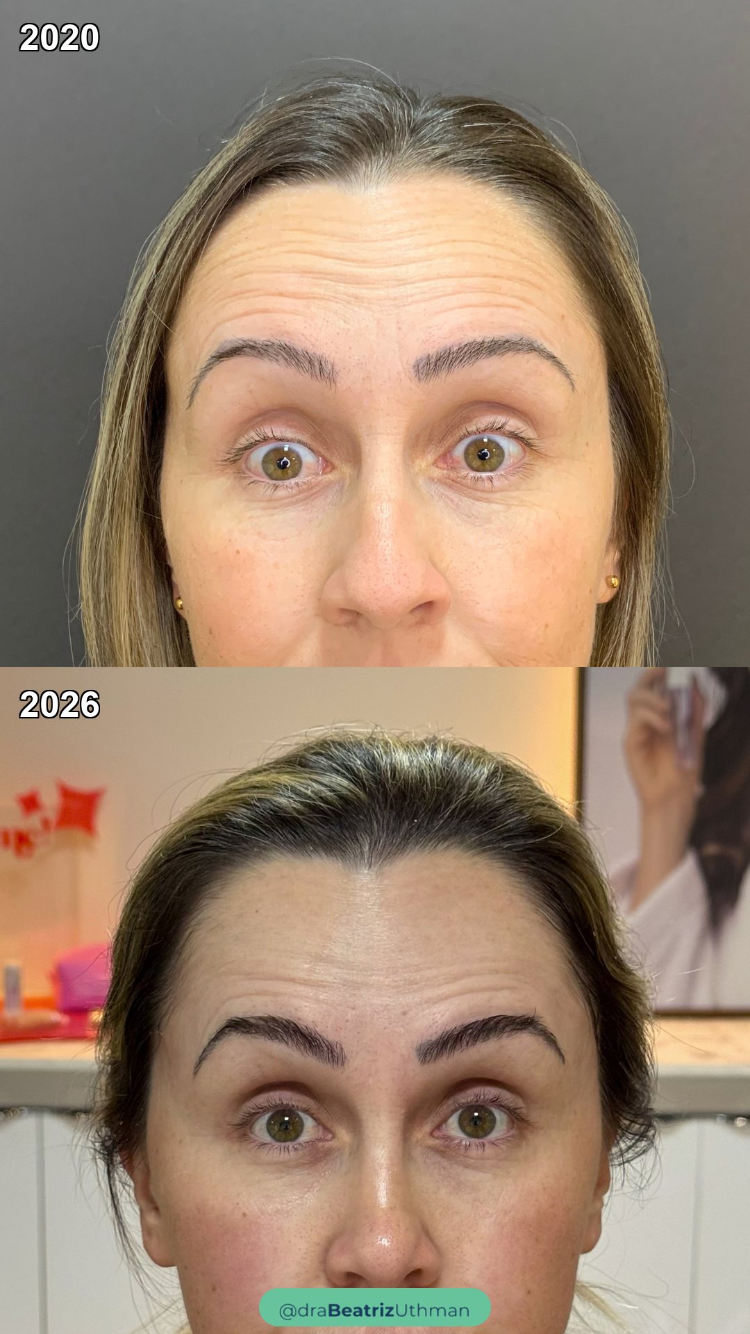 Regularidade · Seis anos de toxina e BIOrregenera: antes e depois
