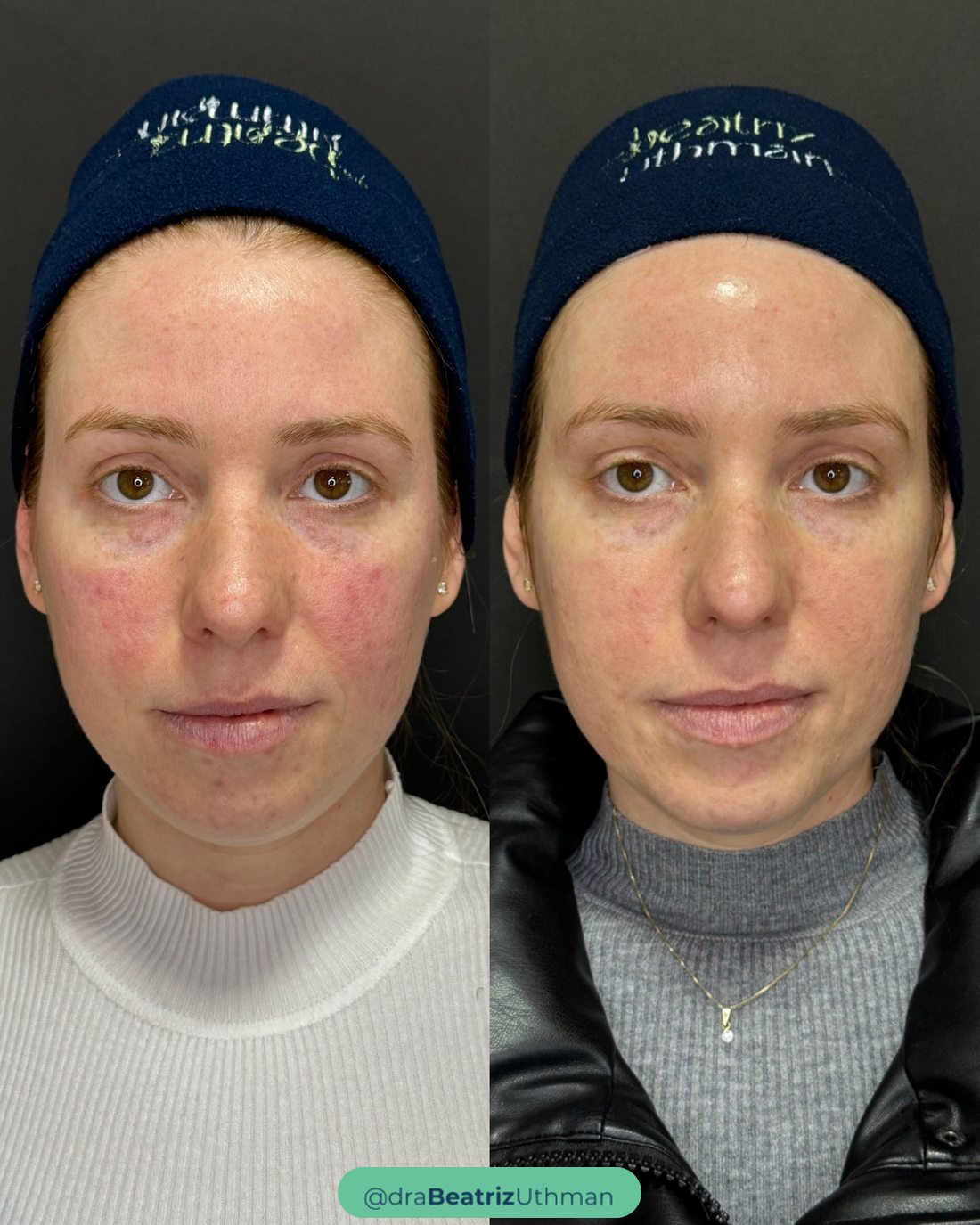Microbotox regenerativo · Rosácea: antes e depois