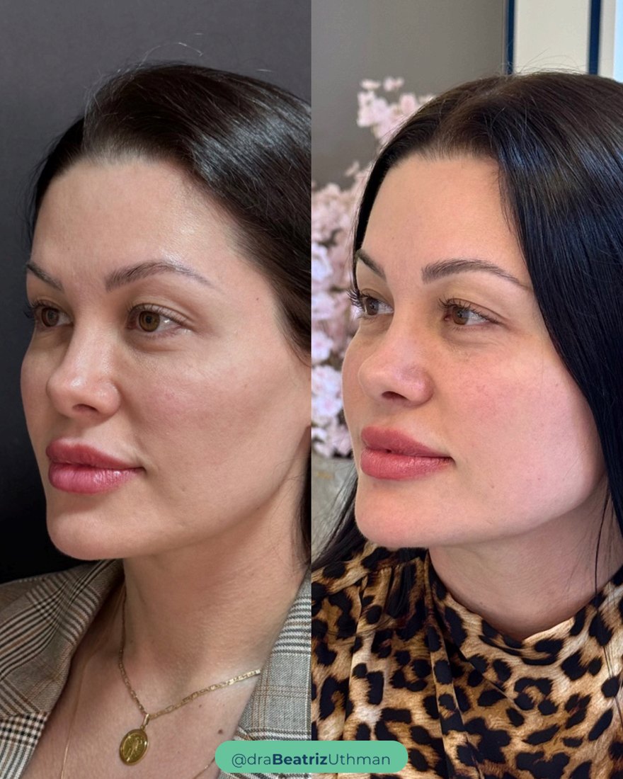 Protocoll · Caso 2: antes e depois