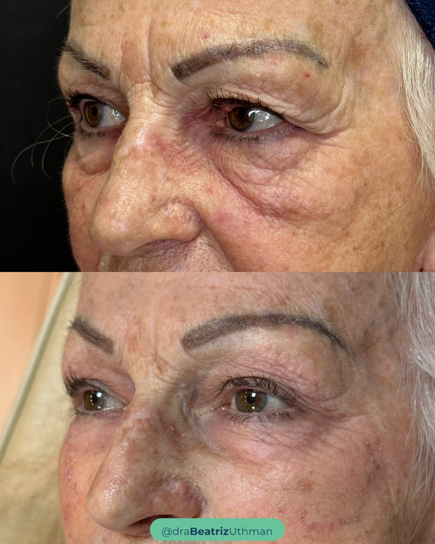 Protocoll · Caso 4: antes e depois