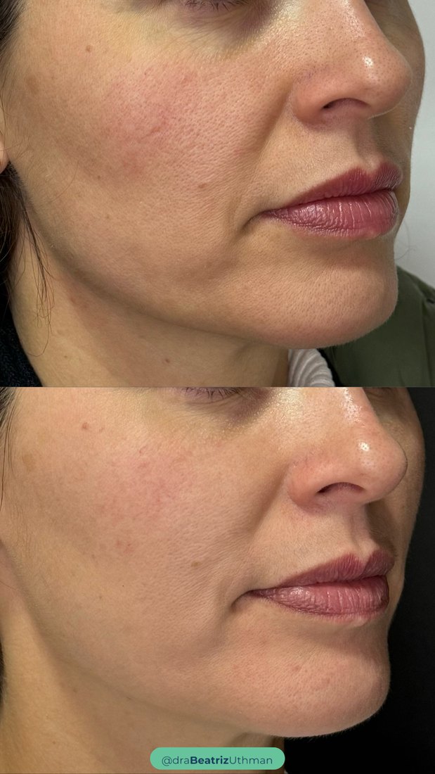 Protocoll · Caso 3: antes e depois