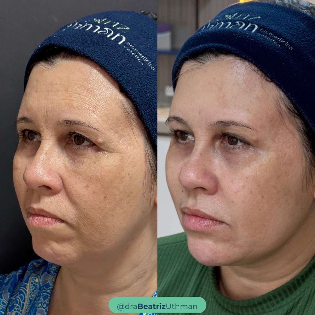 Protocoll · Caso 5: antes e depois