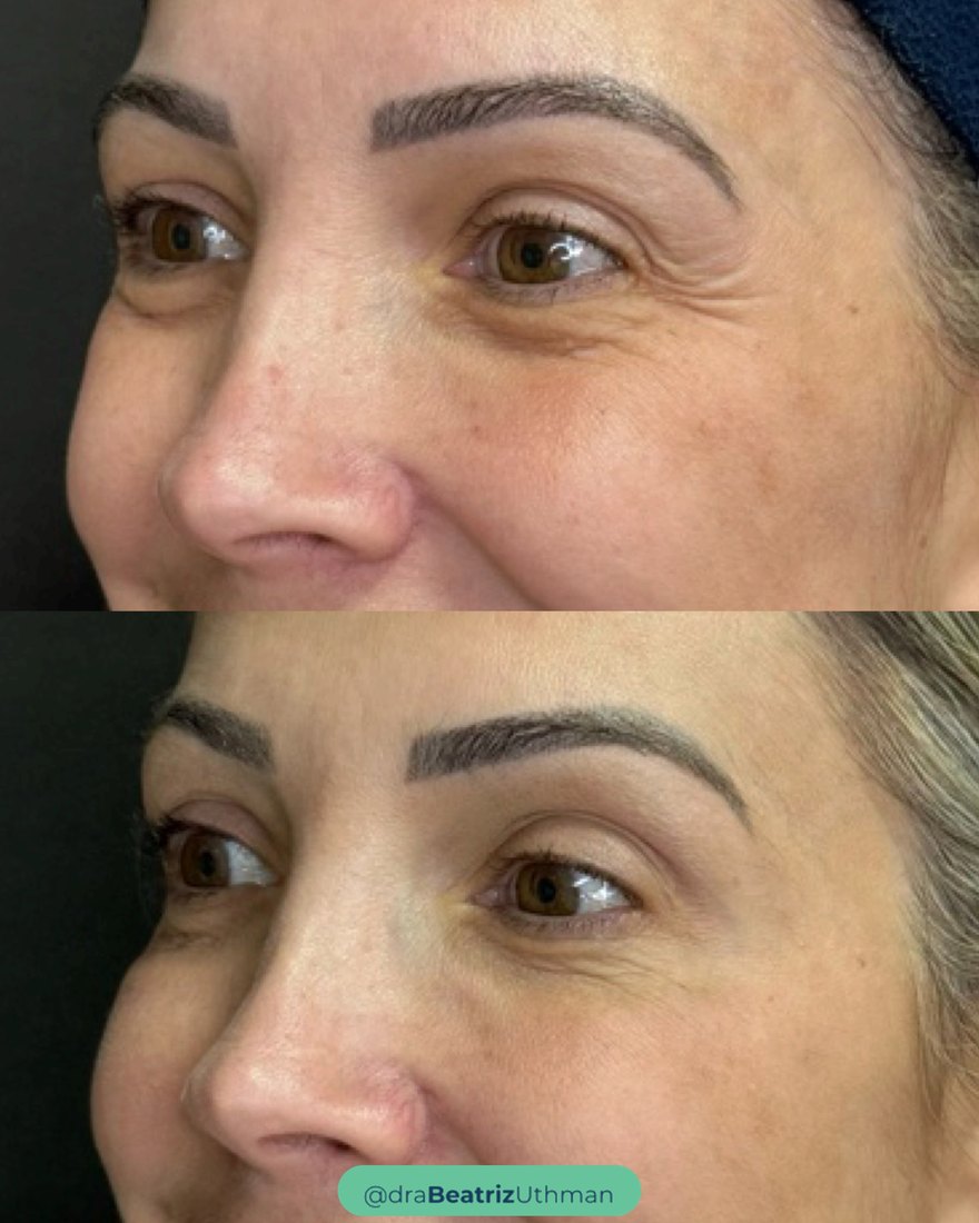 Protocoll · Caso 1: antes e depois