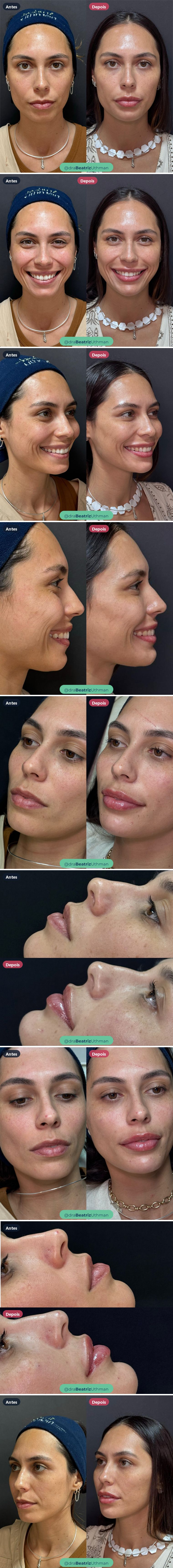 Harmonização · Caso 2: antes e depois