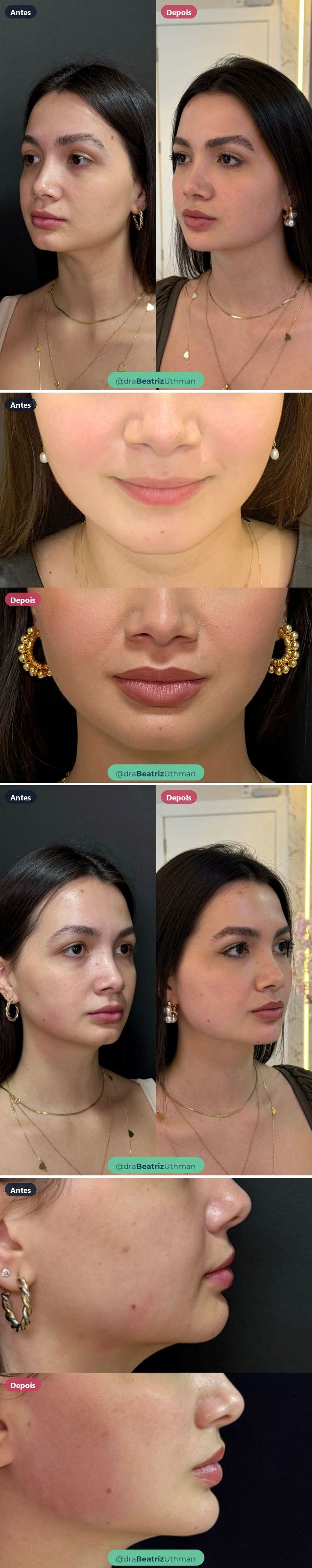 Harmonização · Caso 11: antes e depois