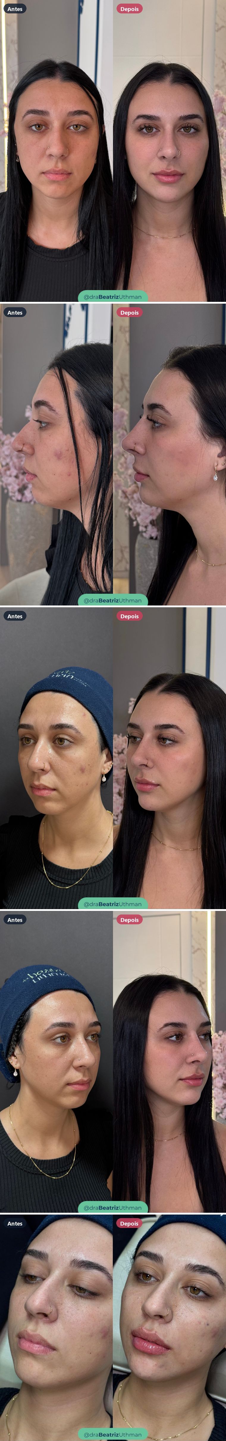 Harmonização · Caso 12: antes e depois