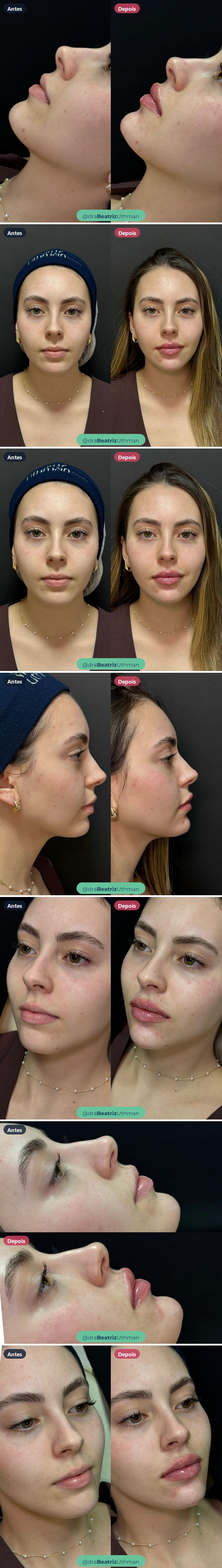 Harmonização · Caso 14: antes e depois