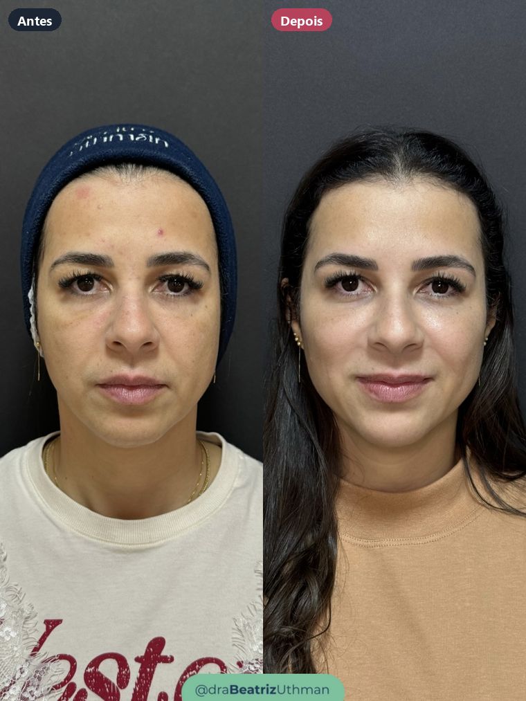 Harmonização · Caso 3: antes e depois