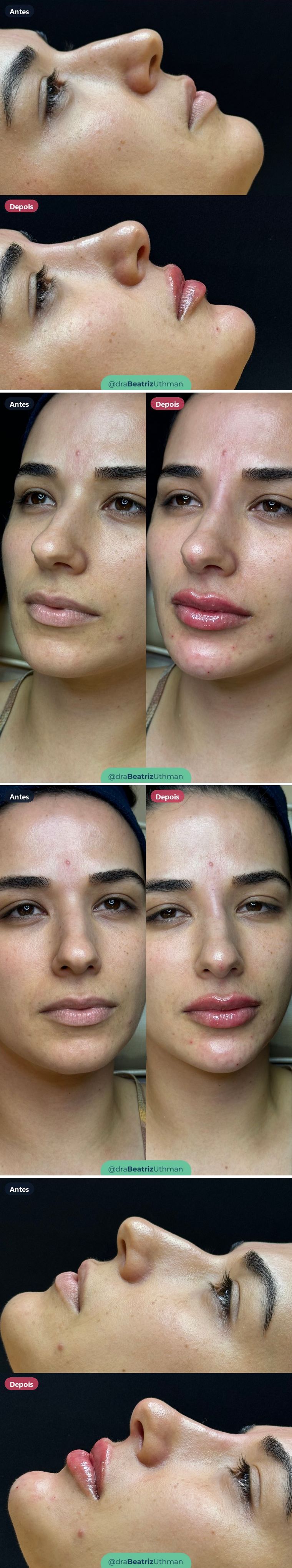 Harmonização · Caso 15: antes e depois