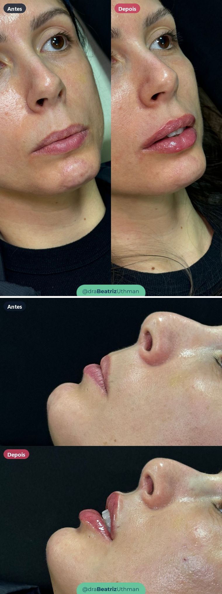 Harmonização · Caso 16: antes e depois