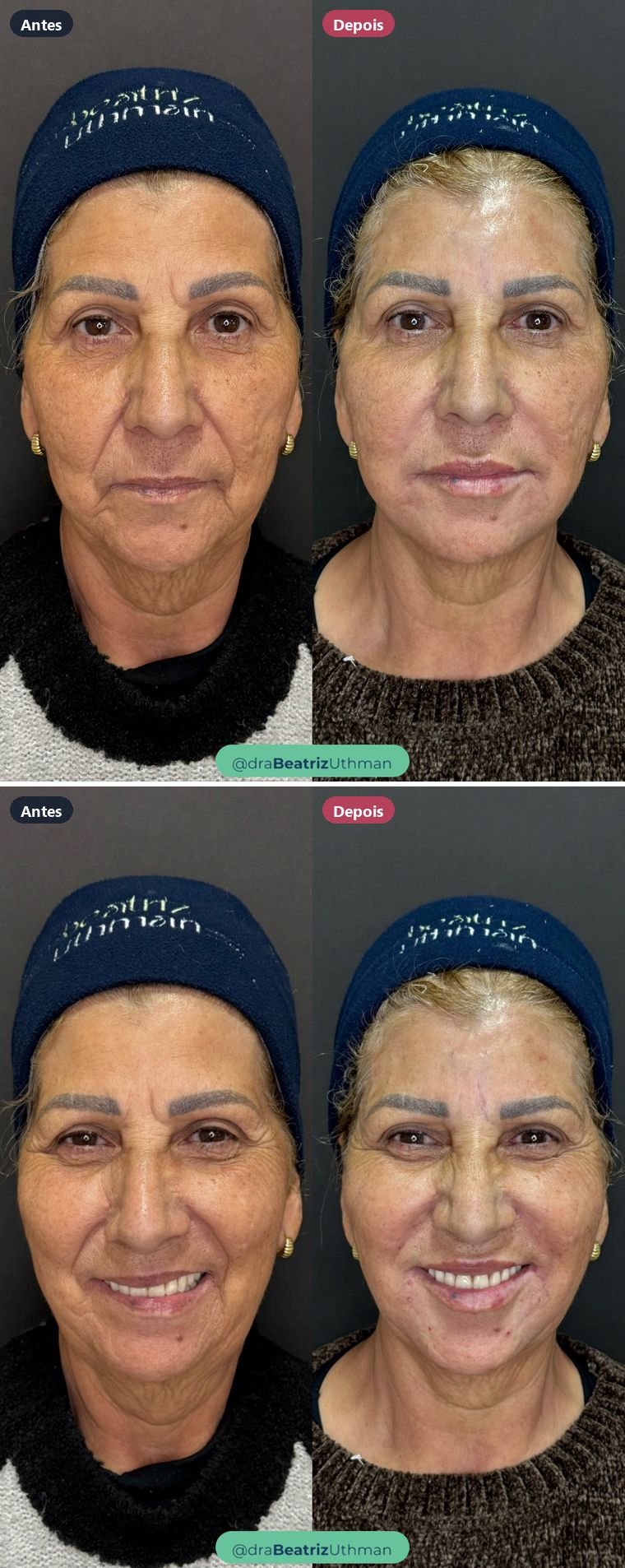 Harmonização · Caso 17: antes e depois