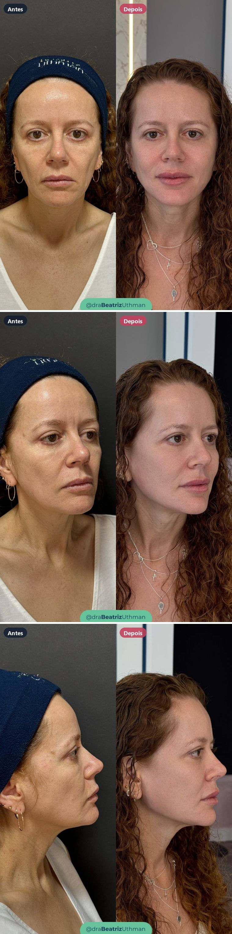 Harmonização · Caso 5: antes e depois