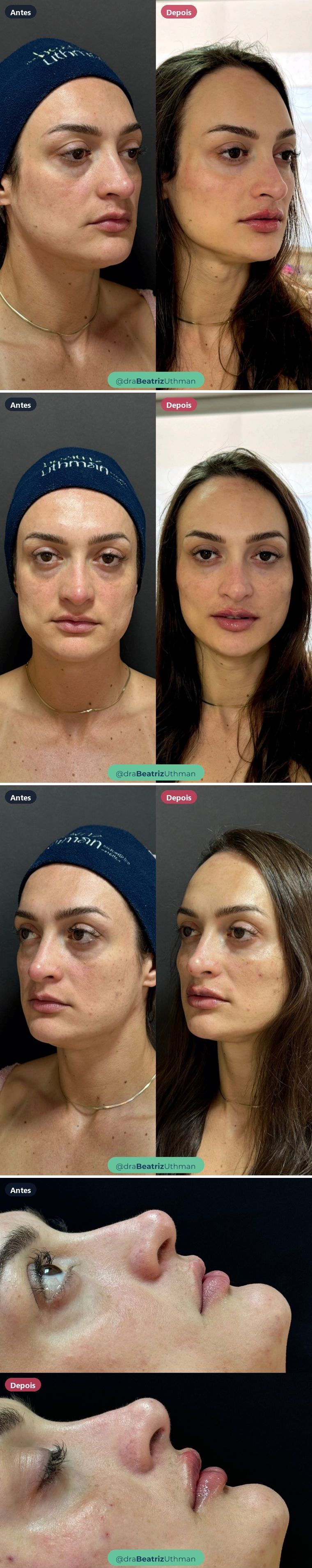 Harmonização · Caso 7: antes e depois