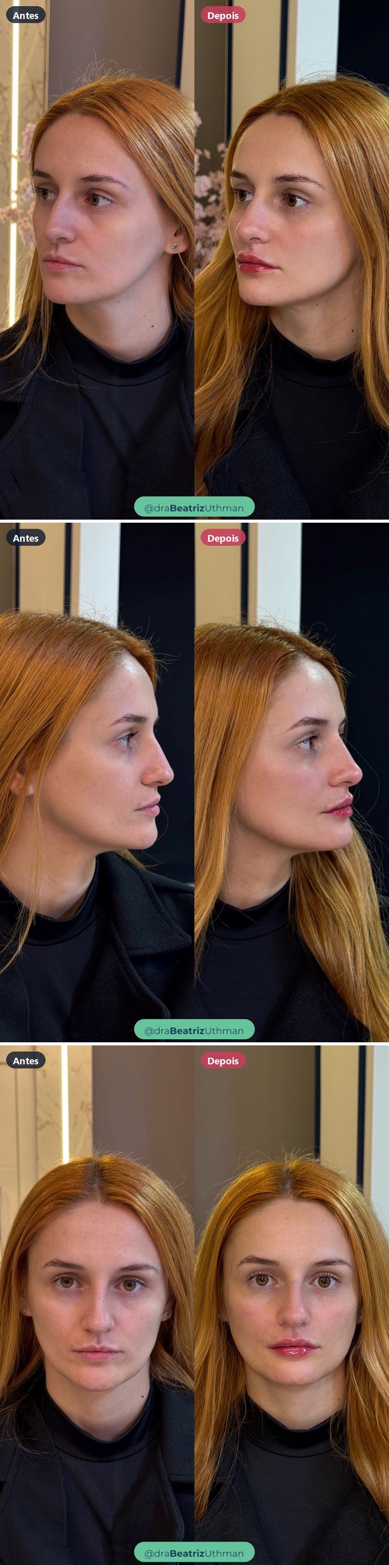 Harmonização · Caso 9: antes e depois