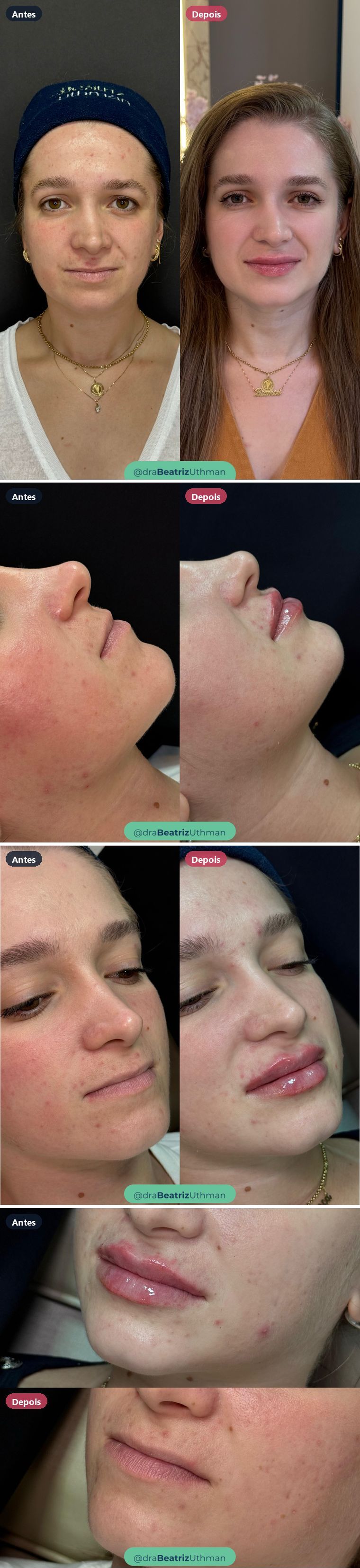 Preenchimento labial · Caso 6: antes e depois