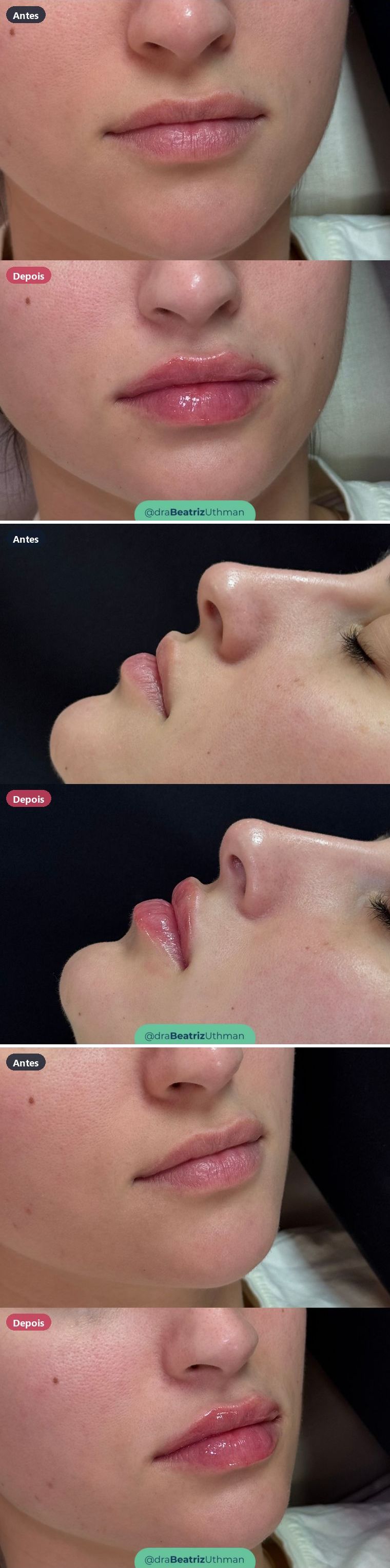 Preenchimento labial · Caso 3: antes e depois