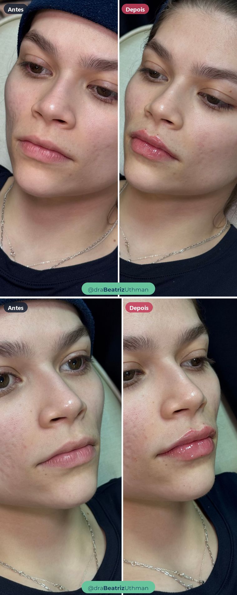 Preenchimento labial · Caso 5: antes e depois