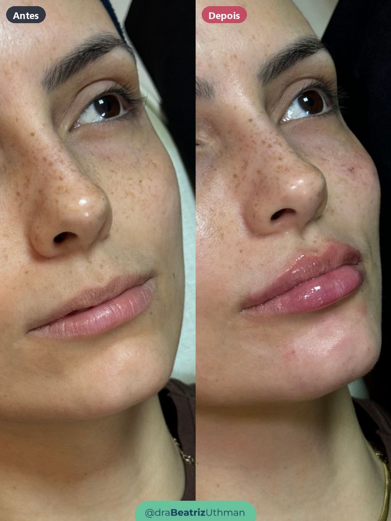Preenchimento labial · Caso 4: antes e depois