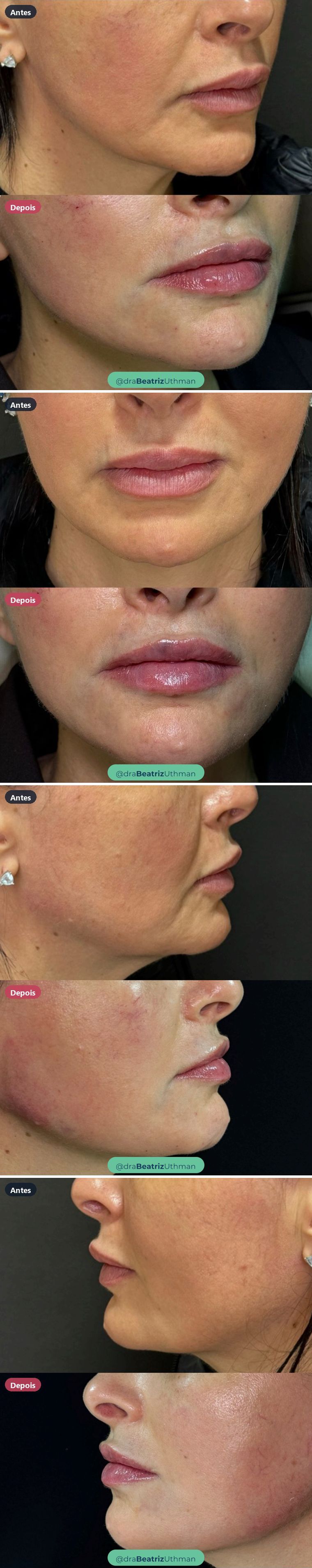 Preenchimento labial · Caso 7: antes e depois