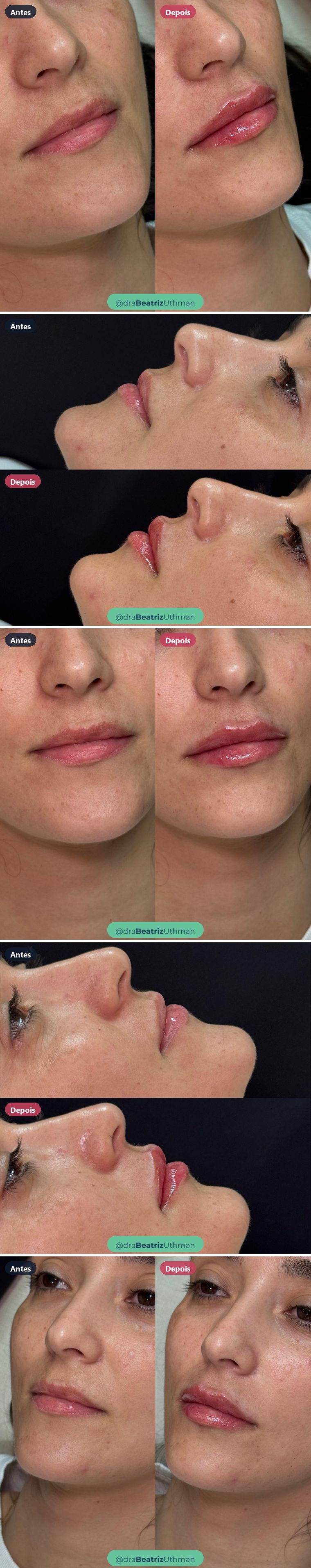 Preenchimento labial · Caso 8: antes e depois