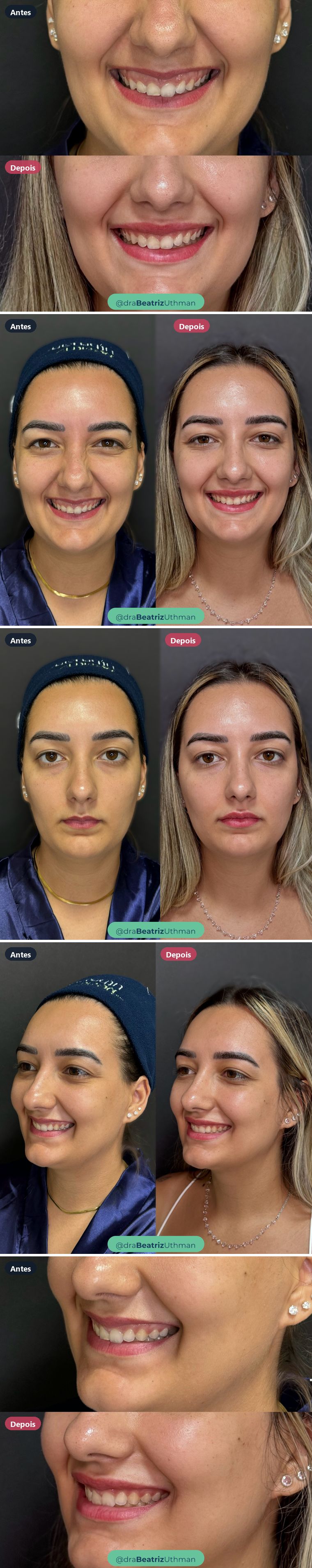 Preenchimento labial · Caso 9: antes e depois