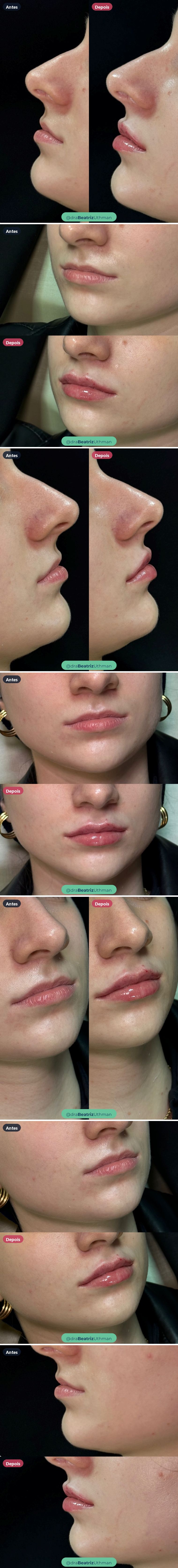 Preenchimento labial · Caso 10: antes e depois