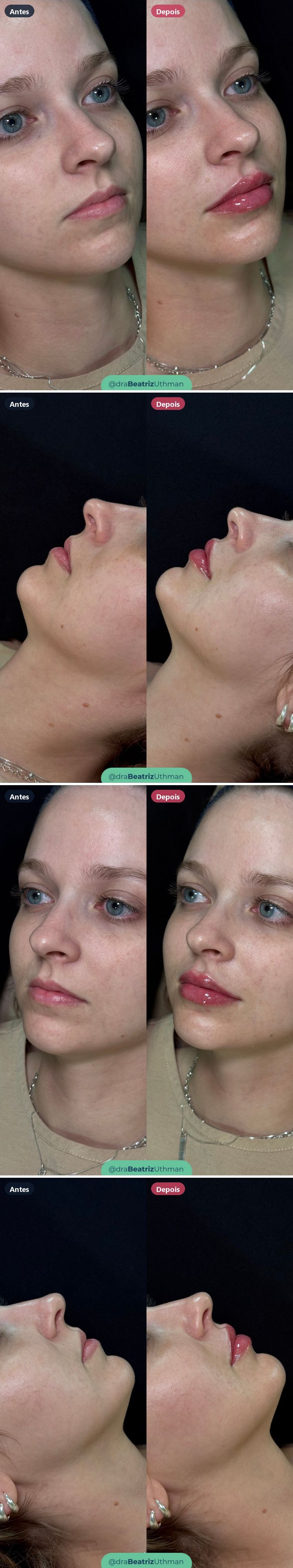 Preenchimento labial · Caso 1: antes e depois