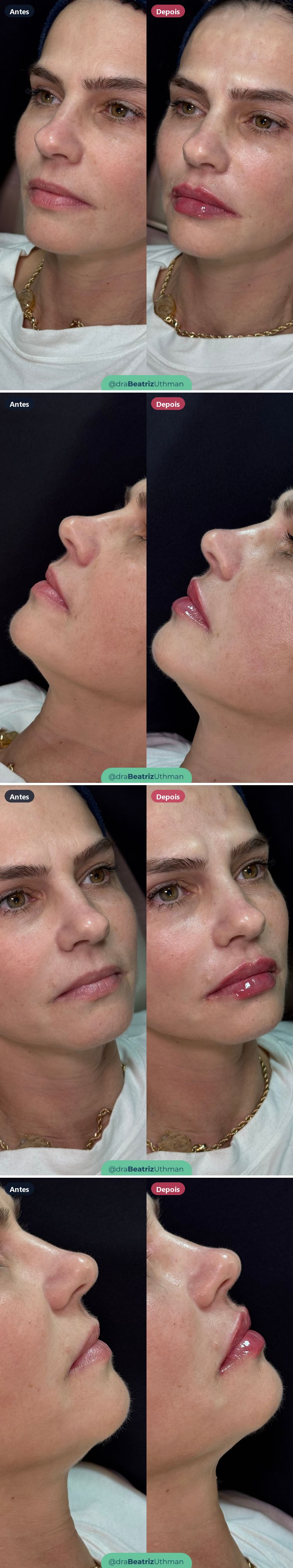 Preenchimento labial · Caso 2: antes e depois