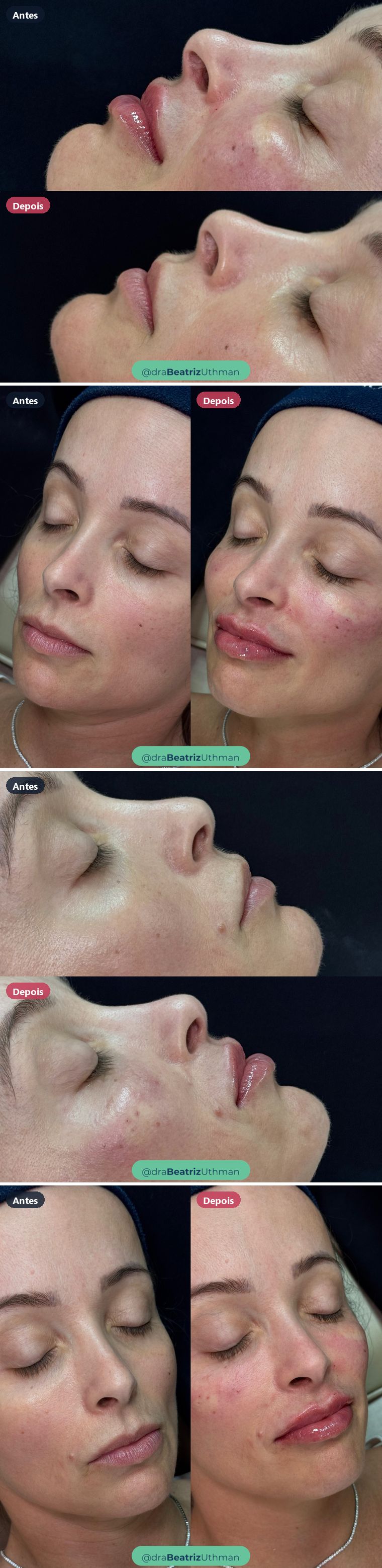 Preenchimento labial · Caso 11: antes e depois