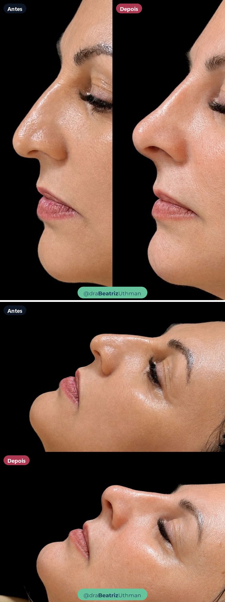 Rinomodelação · Caso 1: antes e depois