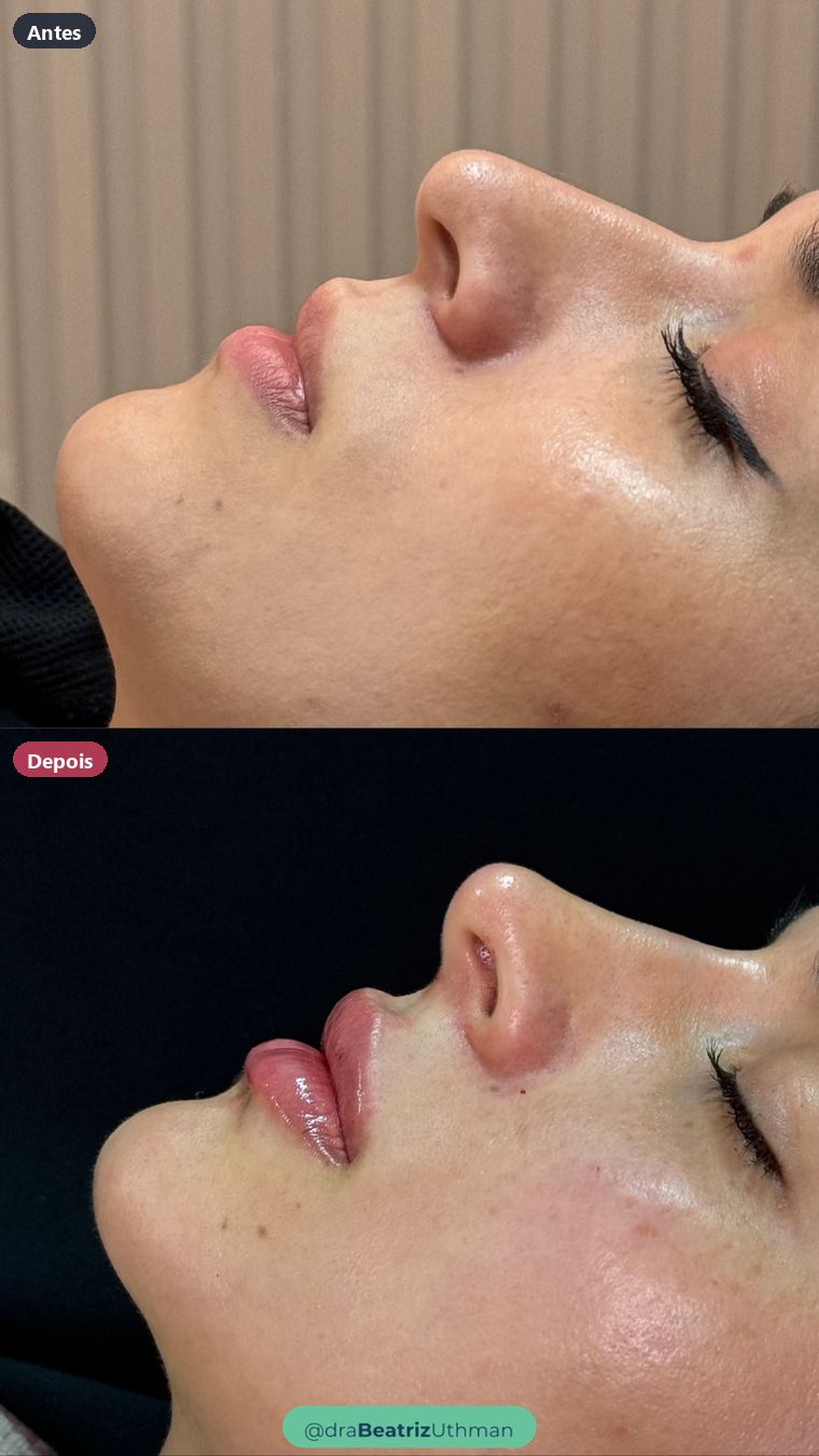Rinomodelação · Caso 11: antes e depois