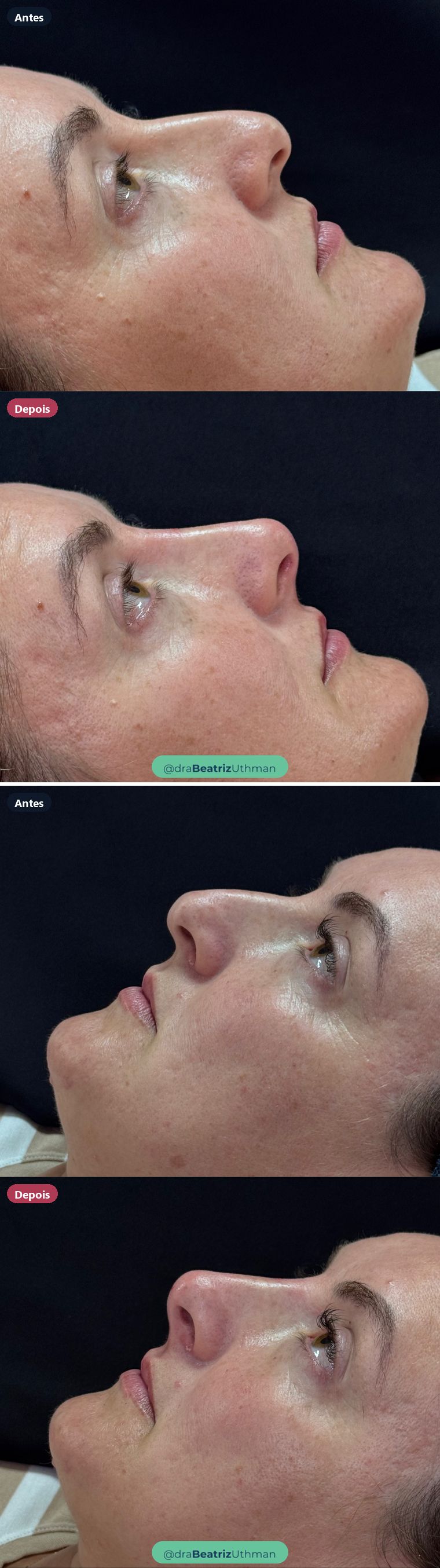 Rinomodelação · Caso 12: antes e depois