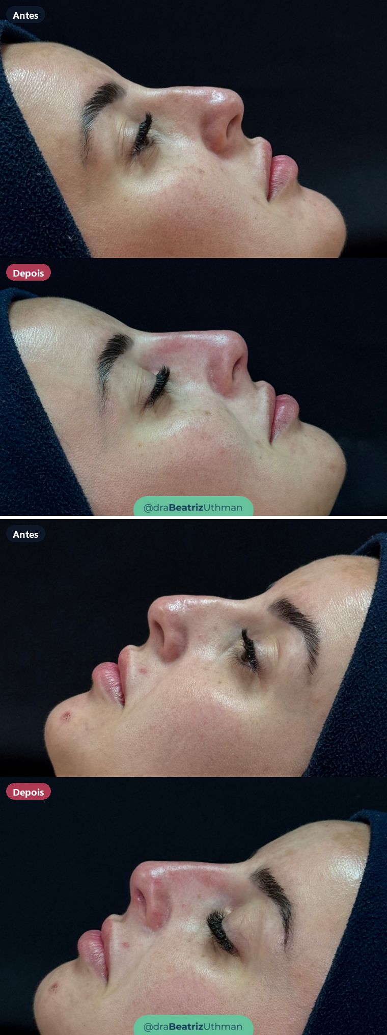 Rinomodelação · Caso 13: antes e depois