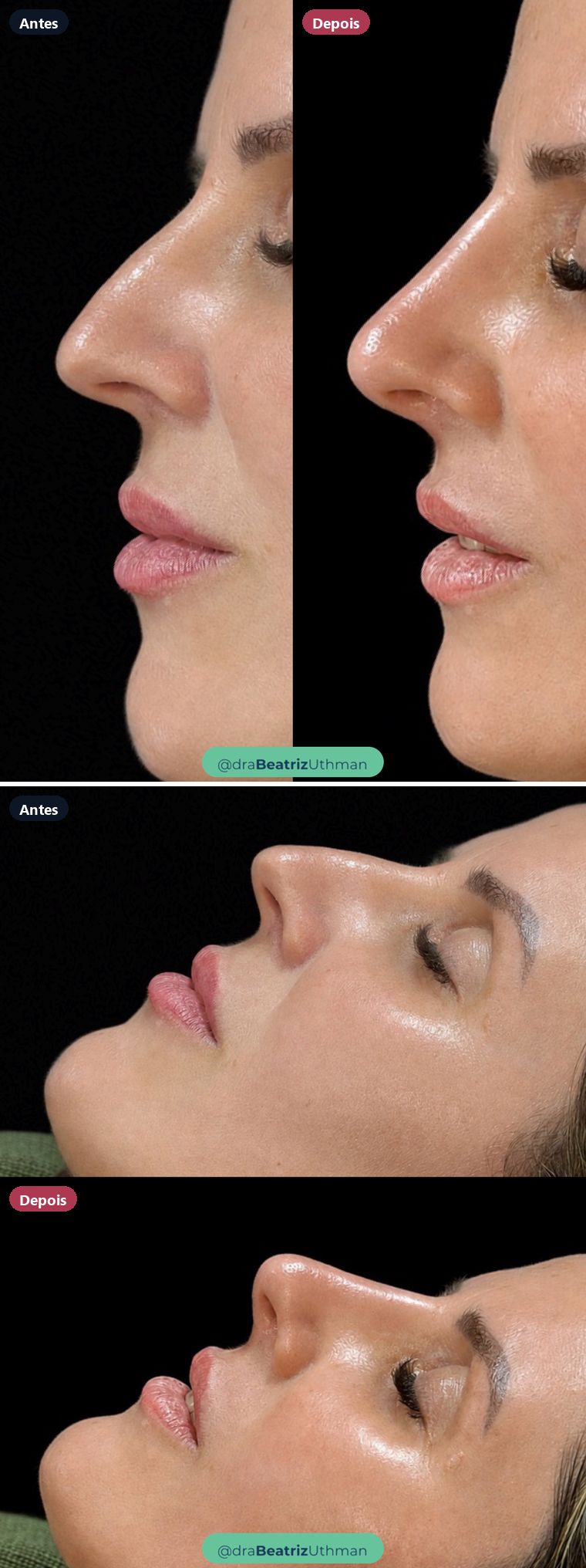 Rinomodelação · Caso 3: antes e depois