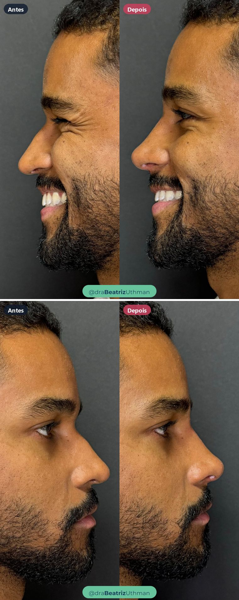 Rinomodelação · Caso 5: antes e depois