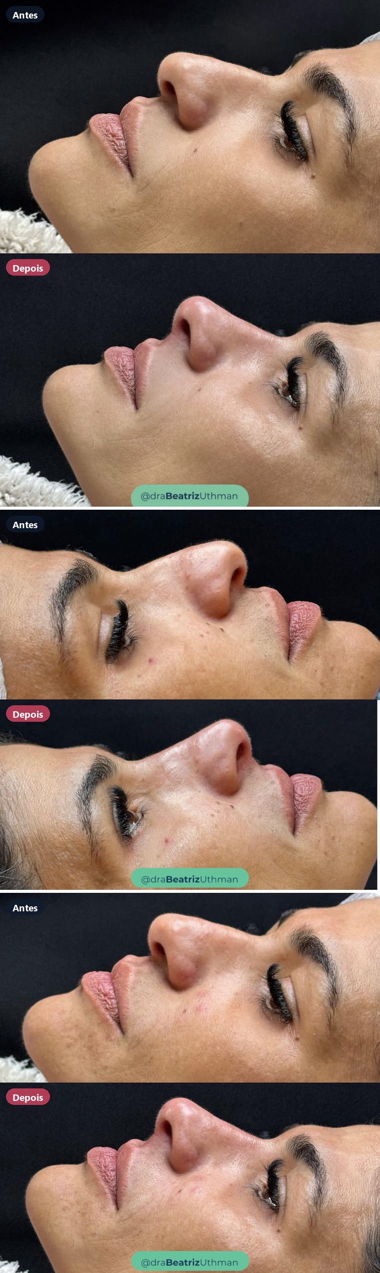 Rinomodelação · Caso 10: antes e depois