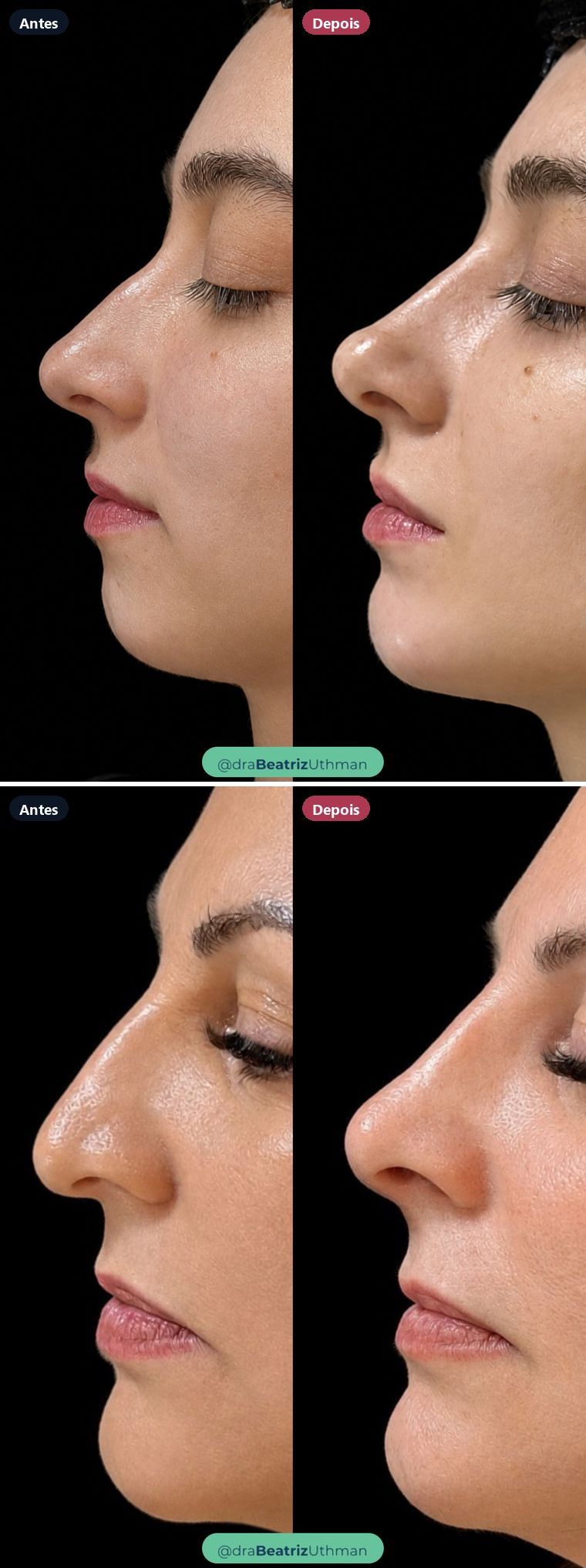 Dois casos de rinomodelação: antes e depois, de perfil